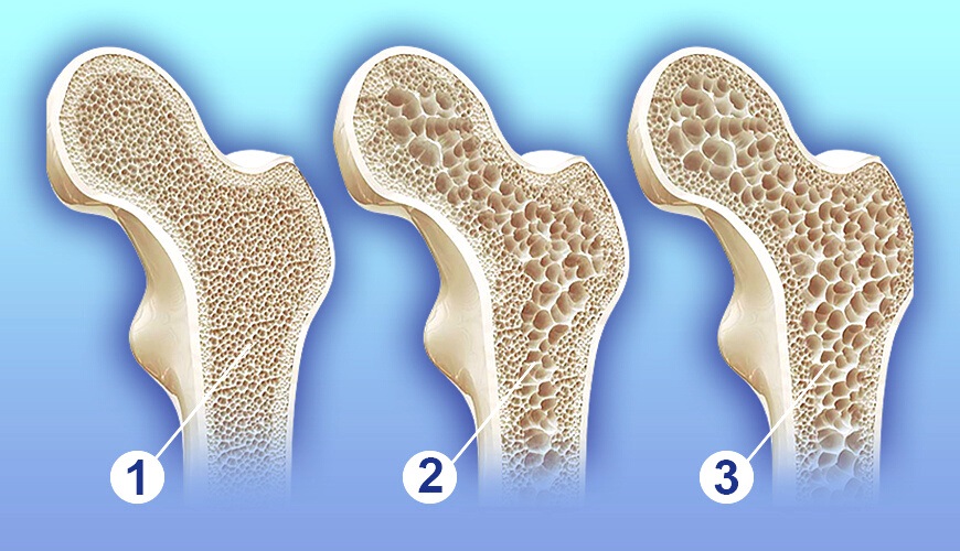 Resim 1. Kemik erimesi durumunda omurgadaki gözeneklerin artarak belirginleşmesi 1.Normal omur   2. Kemik erimesi başlangıcı-osteopeni   3.Kemik erimesi-osteoporoz