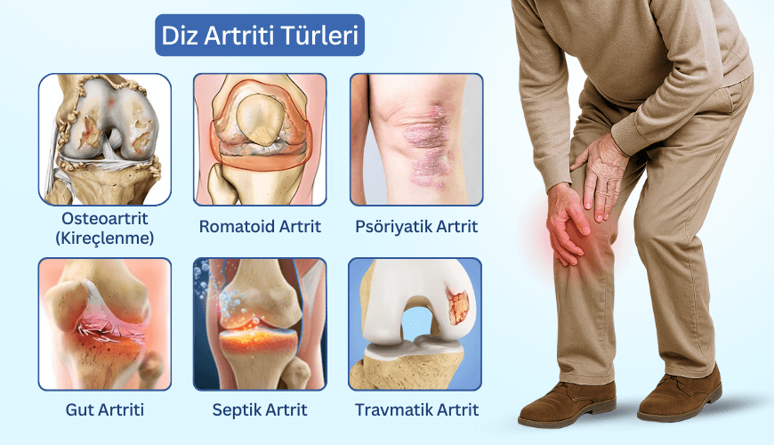 Artrit çeşitleri, dizde ağrı ve şişliğe yol açan sorunlar arasında yer alır.