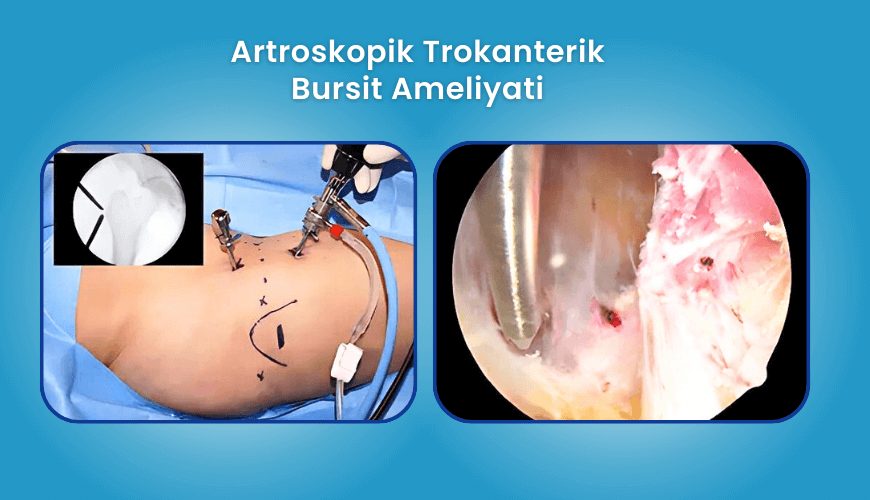 Trokanterik bursit ameliyatı