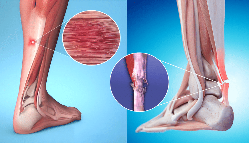 Aşil tendinit (Soldaki görsel) ve aşil tendon kopması (Sağdaki görsel)
