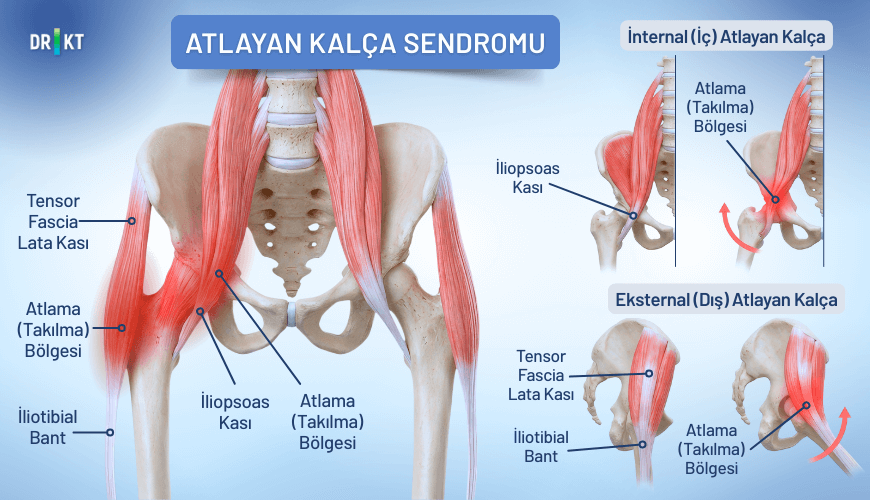 Kalça eklemindeki tendonların kemik çıkıntılarına sürtünmesi, hareket sırasında ses oluşumuna ve kalça ile birlikte kasık ağrısına yol açabilir.