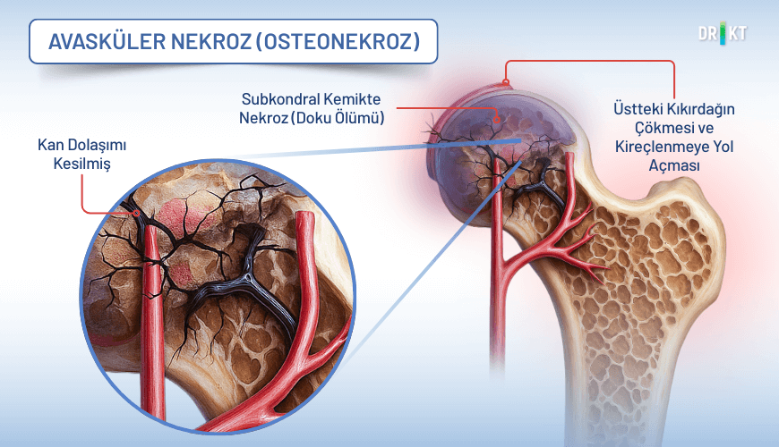 Kemik dokusuna giden kan akışının kesilmesiyle oluşan avasküler nekroz (osteonekroz), kemiğin ölmesine ve bunun sonucunda şiddetli bir eklem ve kemik ağrısı yaşanmasına neden olur.
