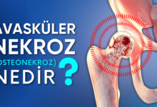 Avasküler Nekroz nedir