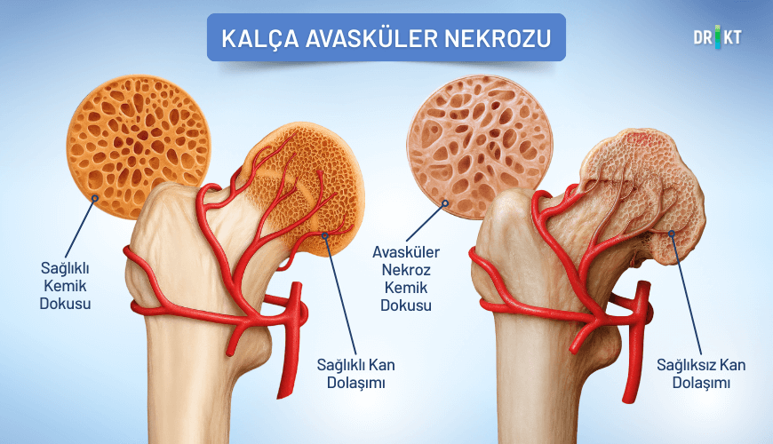 Kalça eklemindeki hücrelerin canlılığını yitirmesiyle oluşan kalça avasküler nekrozu, yürürken kötüleşen kalça ağrısı ile fark edilebilir.
