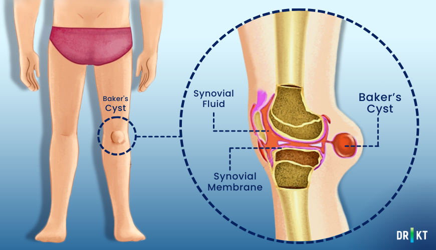  Baker's cyst and its formation