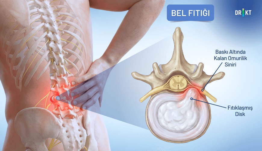 Bel bölgesindeki sinirlerin bel fıtığı nedeniyle sıkışması, belden yayılan bir kasık ağrısına neden olabilir.