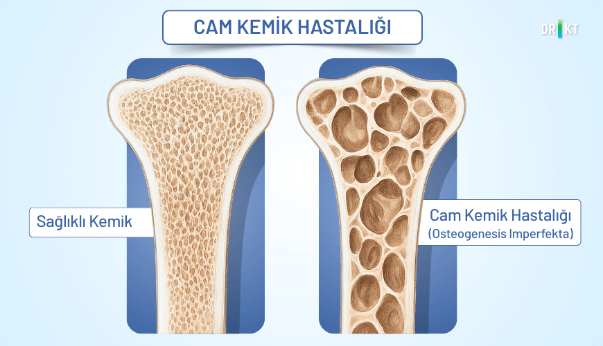 Osteogenesis imperfecta, yani cam kemik hastalığı, kemiklerin zayıf yapısı nedeniyle en ufak bir darbede bile kırılabildiği ve bunun sonucunda şiddetli kemik ağrısı yaşandığı bir rahatsızlıktır.