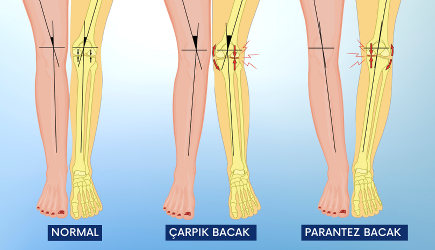 Parantez bacak veya çarpık bacak sorunu olan kişilere kısmi diz protezi ameliyatı tavsiye edilmemektedir. 