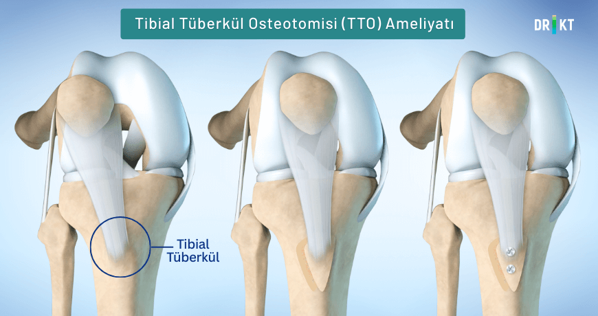 Bir diğer diz kapağı kayması ameliyatı -  tibial tüberkül osteotomisi