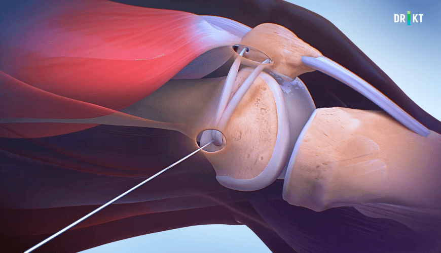 Diz kapağı kayması ameliyatı - Medial Patellofemoral Bağ (MPFL) Rekonstrüksiyonu