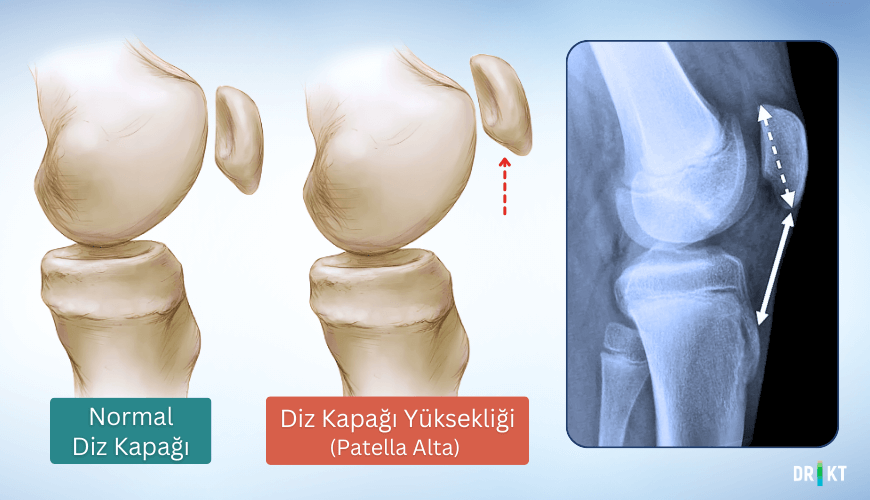 diz kapağı çıkması görüntüsü
