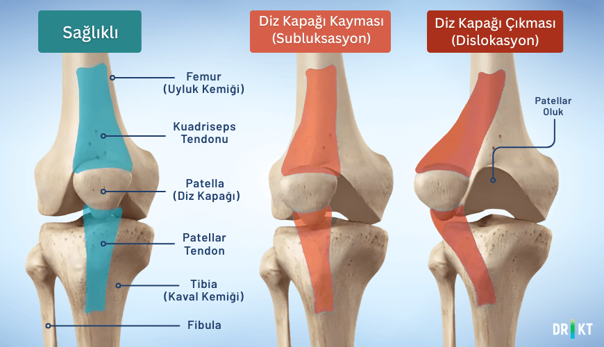 Patella tamamen kaydığında diz kapağı çıkması (dislokasyon), patellanın bulunduğu oluktan kısmen kaydığı durumda ise diz kapağı kayması (subluksasyon) meydana gelir.
