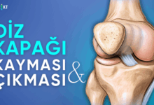 diz kapağı kayması ve çıkması