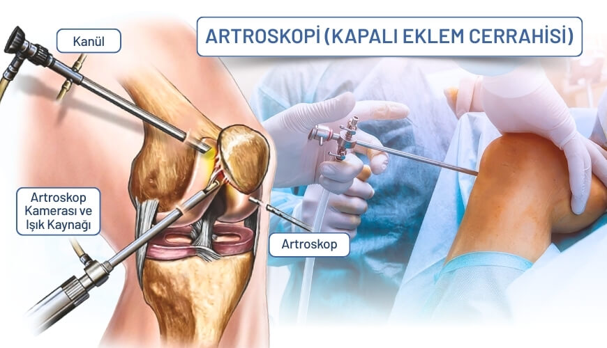 diz kireçlenmesi artroskopi ameliyatı