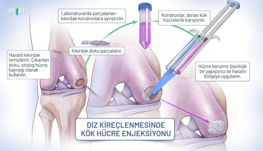 Diz kireçlenmesinde kök hücre enjeksiyonu