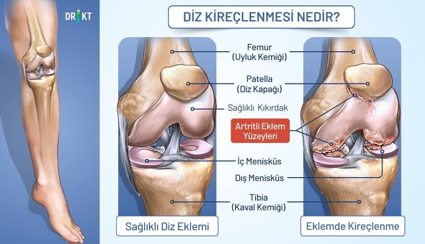 diz kireçlenmesi nedir