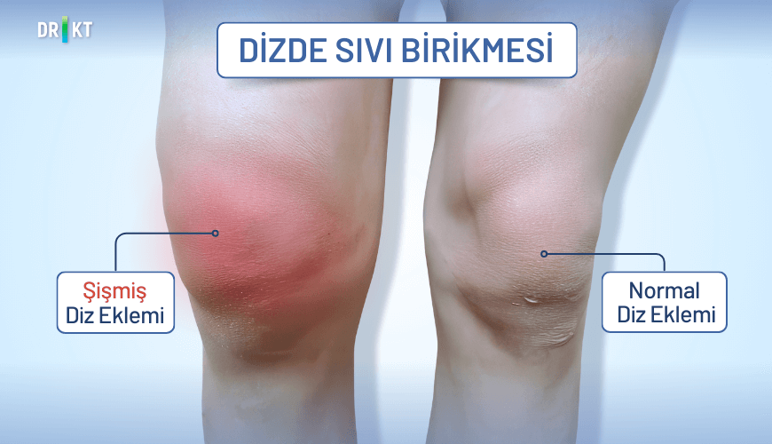  Dizde sıvı birikmesi diz eklemi şişliğe neden olmaktadır. Solda şiş diz eklemi, sağda normal görünümlü diz izlenmektedir.