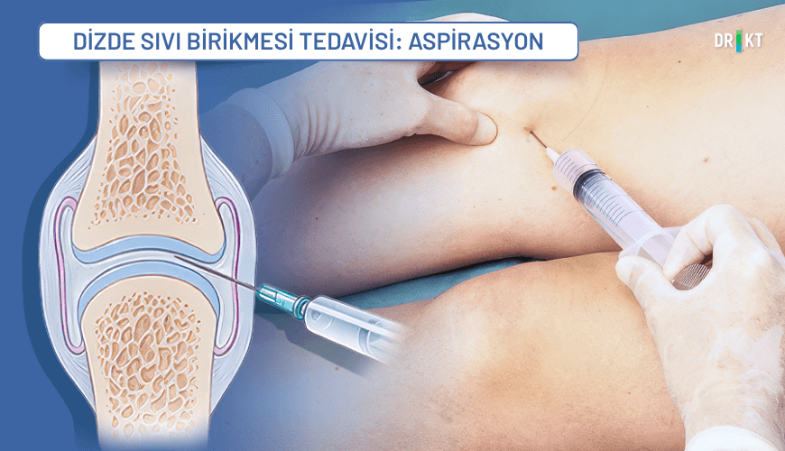 Dizde sıvı birikmesinde eklem sıvısının iğne ile aspirasyonu