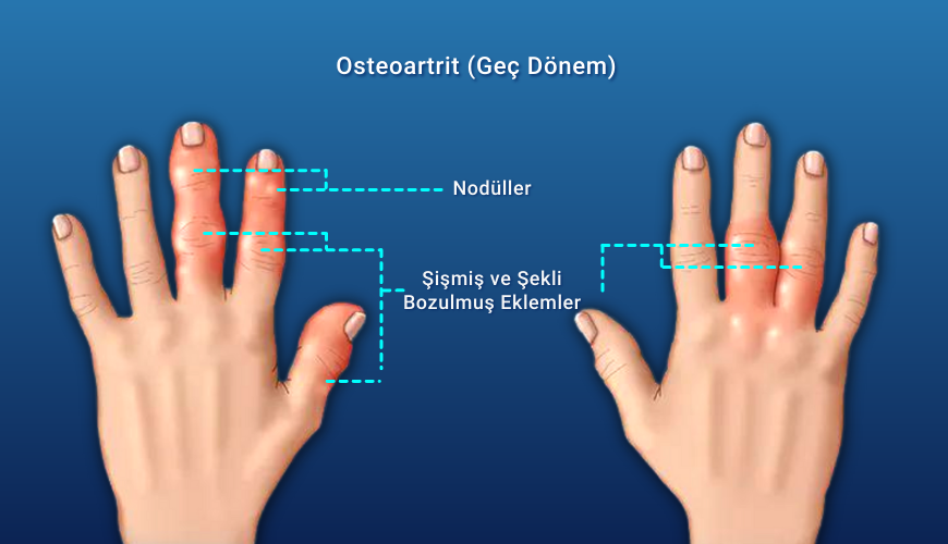 Sıklıkla ellerde görülen nodüler osteoartrit, genetik geçişli bir hastalıktır