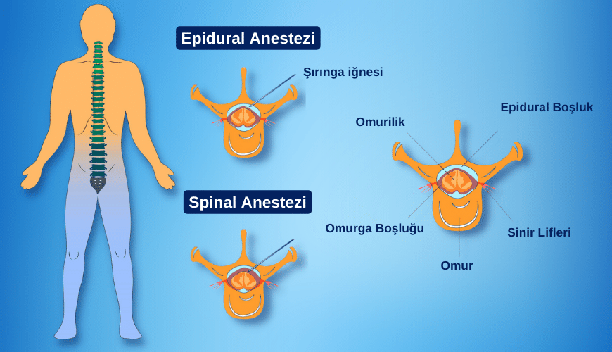 Epidural ve spinal enjeksiyonların uygulanma şekilleri ve etki alanları 