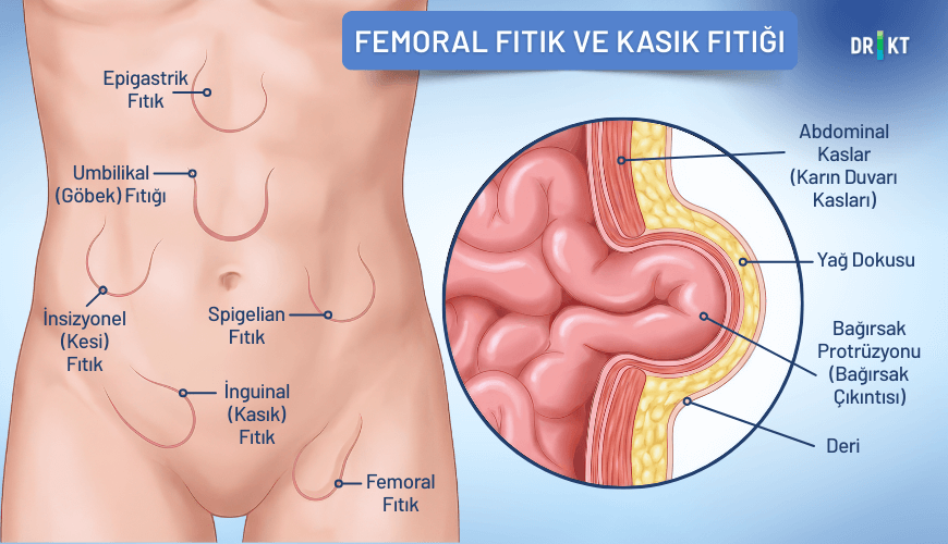 Karın duvarındaki zayıflıklar sonucu oluşan fıtıklar, hareketle artan kasık ağrısı ve şişliğin nedenleri arasında bulunur.