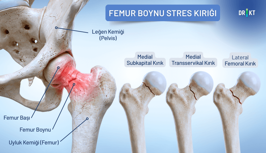 Uyluk ve kasık ağrısına neden olabilen femur boynu stres kırığı, tedavi edilmezse kırığa dönüşebilir.