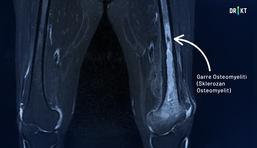 Garre osteomyelitinde apse oluşumu olmaksızın kemikte kalınlaşma meydana gelebilir.