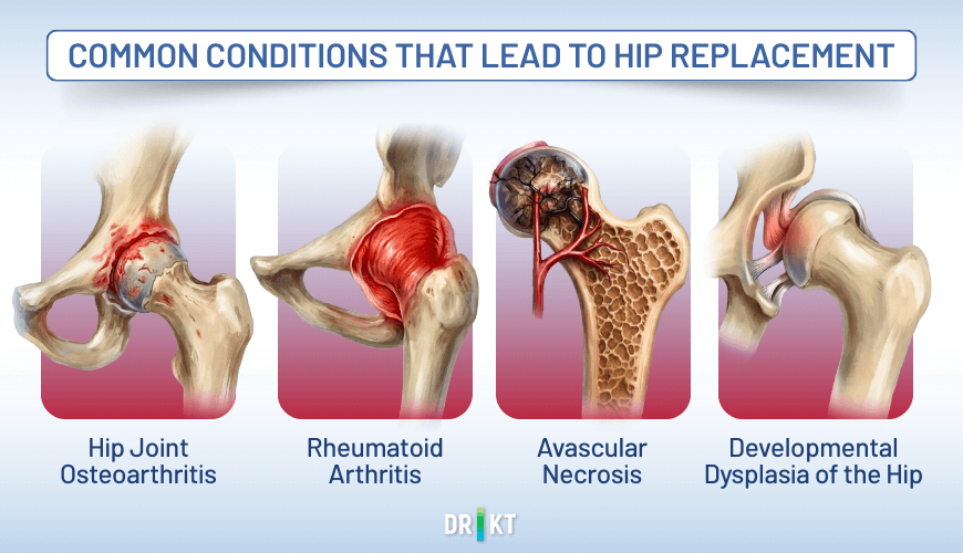 When non-surgical treatments fail to relieve pain from conditions that severely damage the joint, hip replacement surgery is a proven and effective solution to improve quality of life.