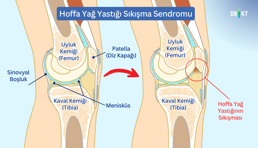 Diz kapağının altında bulunan Hoffa yağ yastığının diz eklemi içerisinde sıkışması sonucu dizde ağrı oluşabilir.