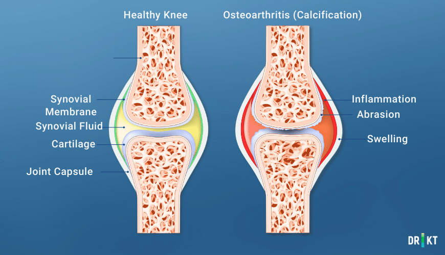 hydrogel treatment of knee arthritis (Liquid Knee Replacement)