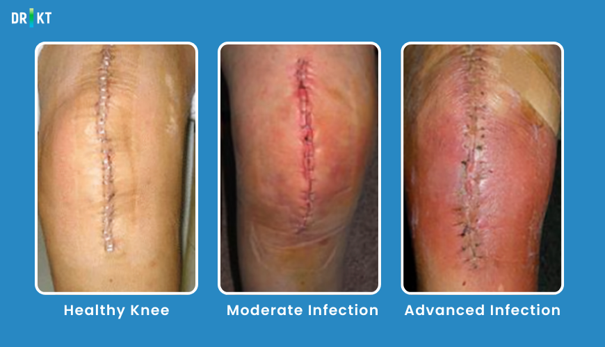 infection after prosthesis surgery