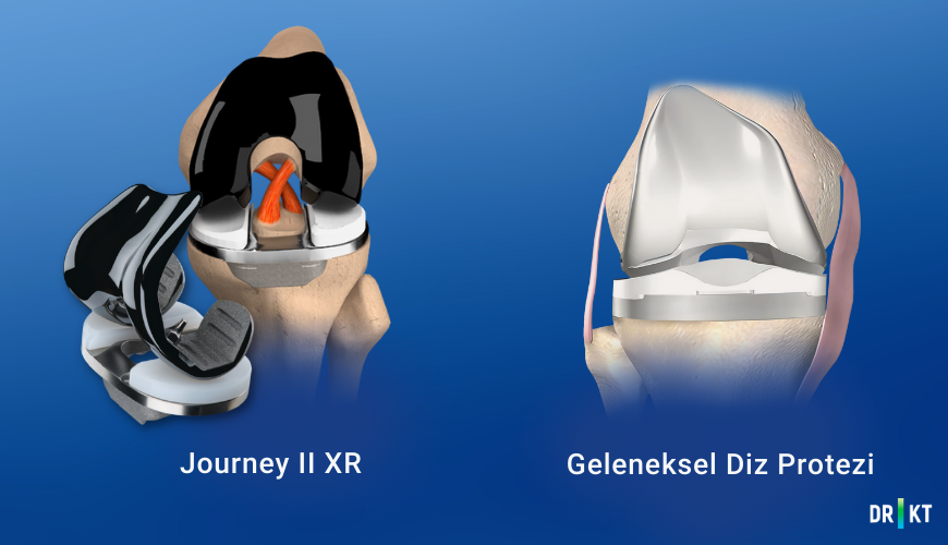 journey 2 xr ve geleneksel diz protezi farkı