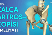 kalça artroskopisi nedir, ameliyatı