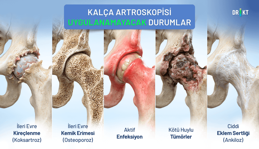 kalça artroskopisi hangi durumlarda uygulanmaz