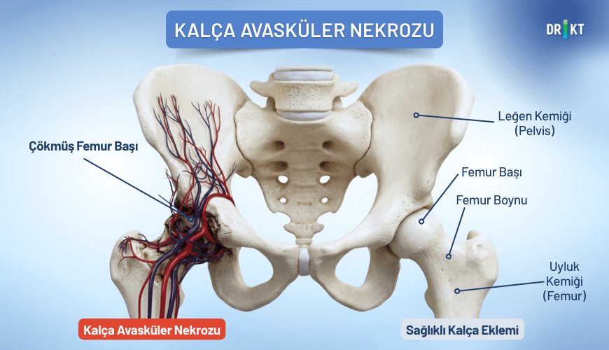 Uyluk kemiğindeki kan dolaşımının bozulması, kalçadan başlayıp yayılan kasık ağrısı yaratabilir