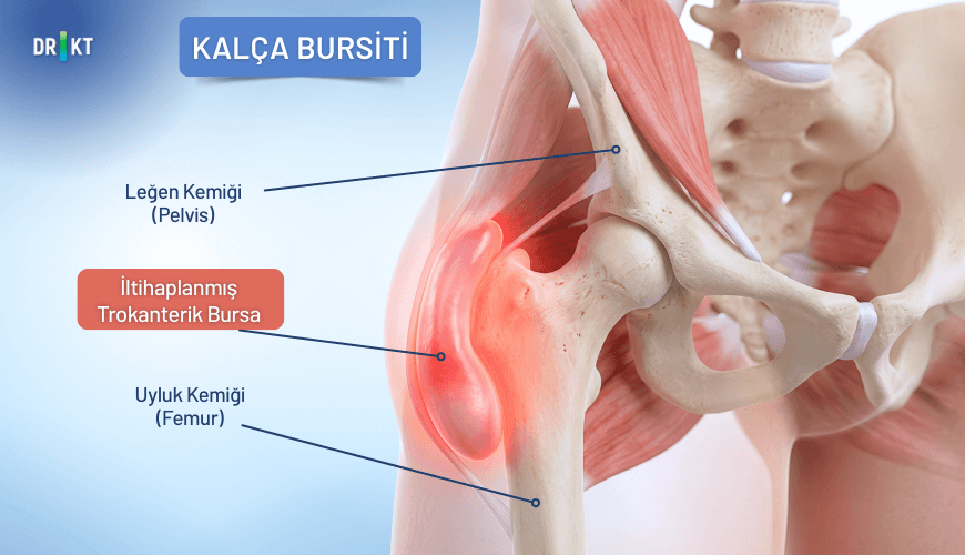 Kalça ekleminin önündeki sıvı dolu keseciklerin iltihaplanması, kasık ağrısı şikayetinin sebeplerinden biridir