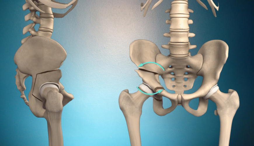 Yetişkinlerde kalça çıkığı ameliyatı “periasetabular osteotomi” yöntemi