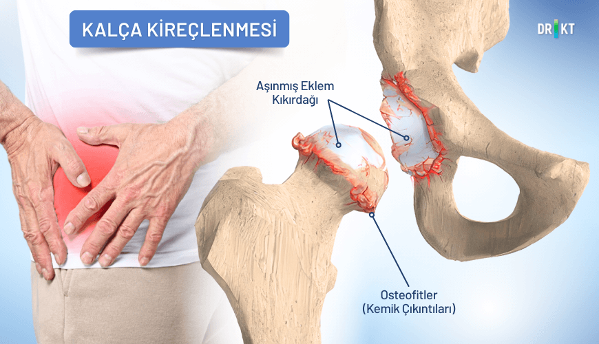 Kıkırdağın zamanla aşınmasıyla kemiklerin birbirine sürtünmesine sebep olan kalça kireçlenmesi, yürürken hissedilen şiddetli bir kalça eklem ağrısı ile sonuçlanabilir.
