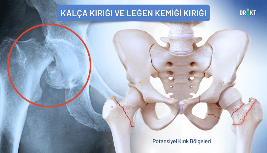 Leğen veya kalça kemiğinde meydana gelen kırıklar, bölgede gelişen şişlik ve morarma ile birlikte şiddetli bir kalça ve kasık ağrısına sebebiyet verebilir.