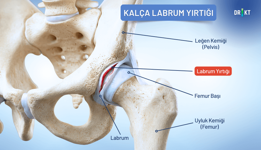 Kalça eklemini koruyan kıkırdak doku olan labrumun yırtılması, bacağa ve bele vuran kasık ağrısı nedenleri arasında bulunur.