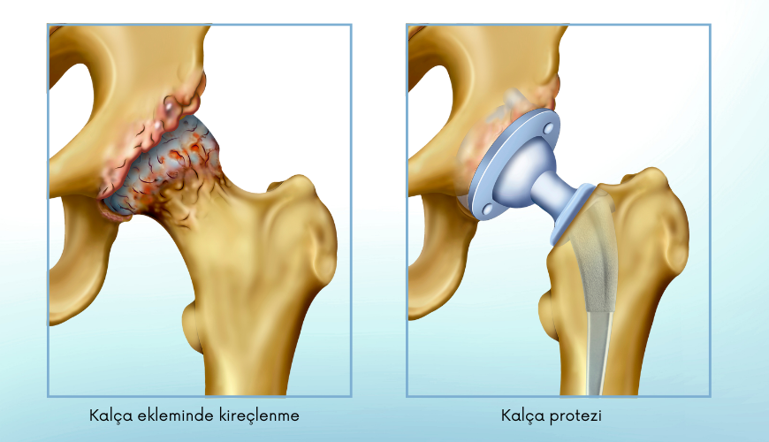 Kalça protezi ameliyatı- solda kalça ekleminde kireçlenme, sağda ise kalça protezi izlenmektedir.