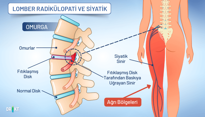 Radikülopati, sinir köklerinin baskı altında kalması sonucu oluşur ve bacak, bel kalça ağrısına neden olabilir.