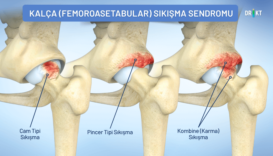  Kalça eklemini oluşturan kemiklerin yapısal uyumsuzluğu nedeniyle meydana gelen kalça sıkışma sendromu, hareket sırasında tekrarlayan sürtünmeye yol açarak yürürken kalça ağrısına sebep olabilir.