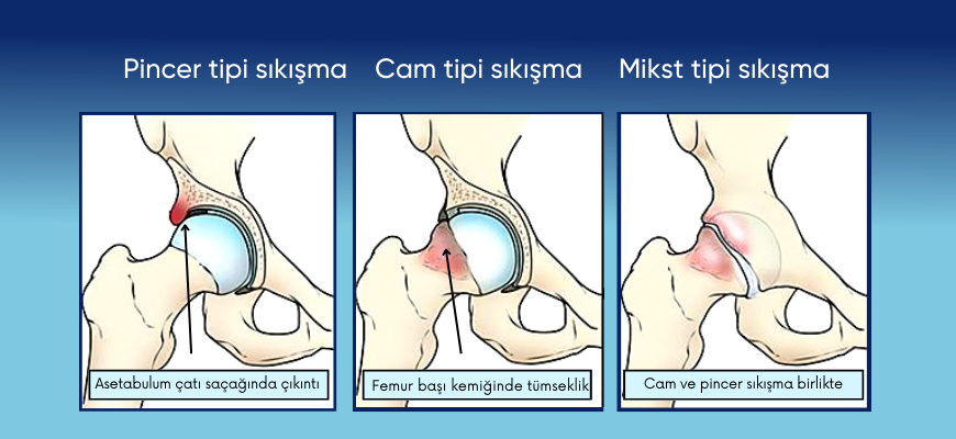 Kalçanın sıkışma sendromlarının tipleri ve kaynaklandıkları noktalar