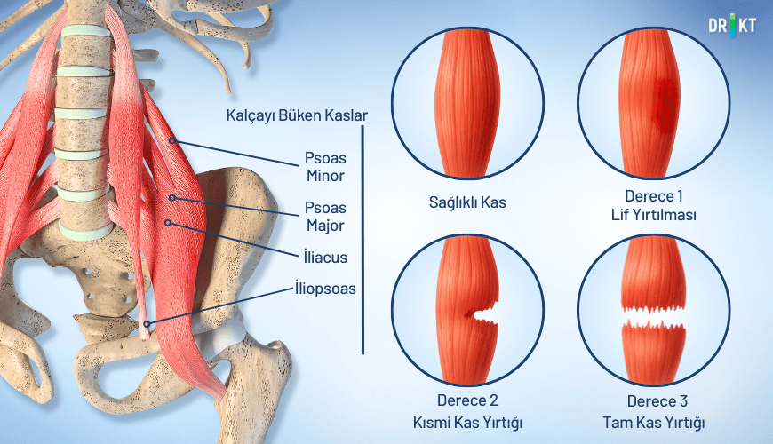 Ani başlayan kalça ağrısı, sporcularda sık görülen kas yırtılması veya tendon kopması ile ilişkili olabilir.
