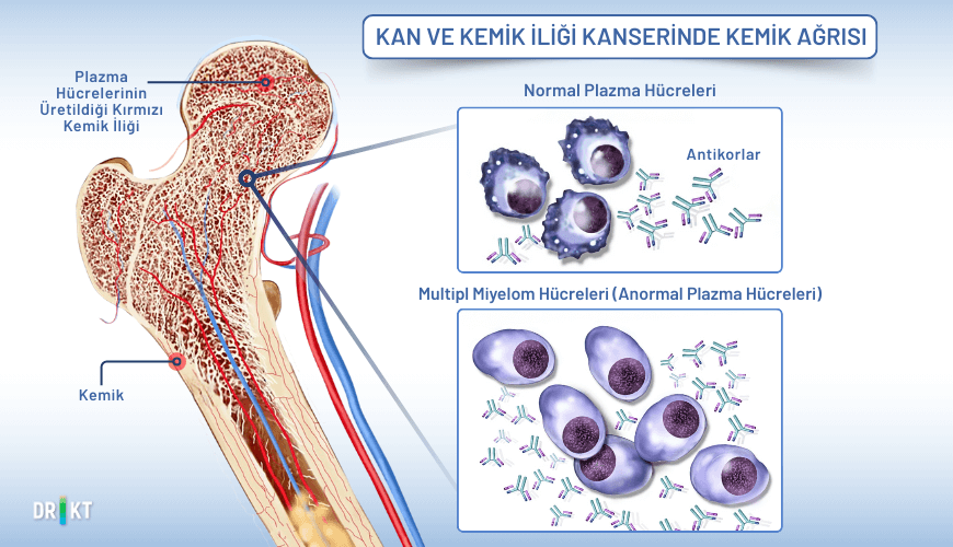 Kan ve kemik iliği kanseri, sağlıklı kan hücrelerinin üretimini engelleyerek kemik ağrısı ve yorgunluğa neden olabilir.