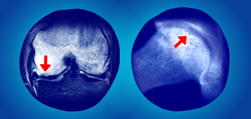 Dizdeki (sol) ve kalçadaki (sağ) subkondral bölgelerde “hilal” şeklinde gerçekleşen eklem çökmesi.