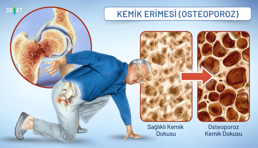  Kemik erimesi nedeniyle zayıflayan kemikler, en ufak bir düşmede bile kırılarak şiddetli bir kalça ağrısı yaratabilir.