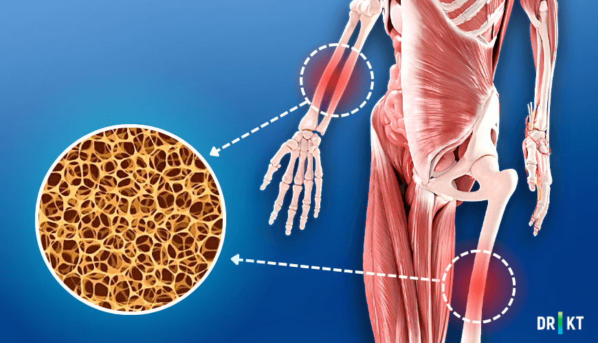 Kemik erimesi (osteoporoz) yaşandığında yüksek tibial osteotomi ameliyatının başarı oranı düşüktür.