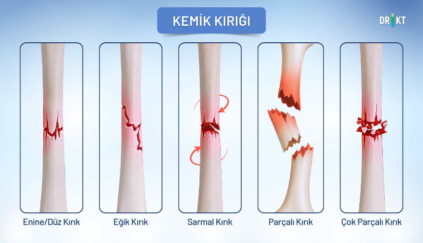 Düşme ya da darbe alma gibi travmalar sonucunda oluşan kemik kırığı, hareket kısıtlılığına ve şiddetli kemik ağrısına yol açabilir.